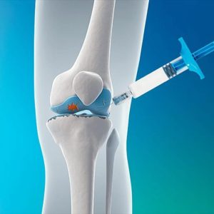 Knee Renewal Injection (1Treatment)